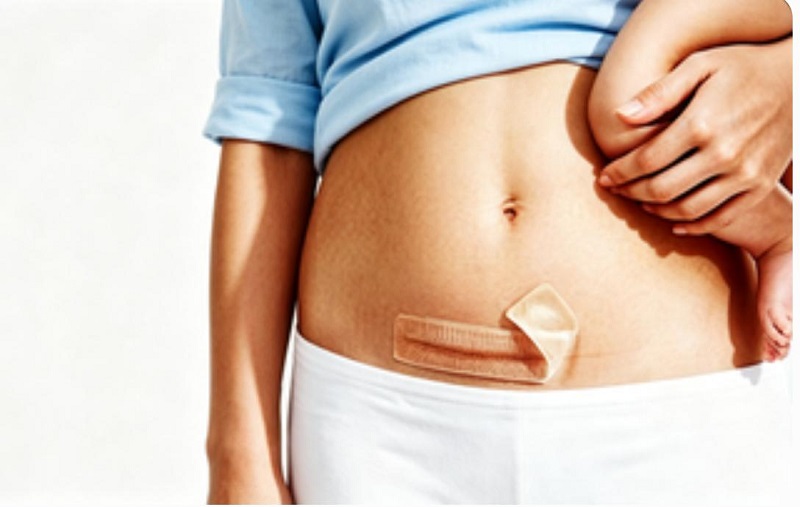 Paiste Scar CmallBio Silicone Sábháilte Saor ó Hormone le haghaidh Cúram Scar Alt Cesarean